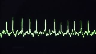 Common heart dysrhythmias atrial fibrillation AF and first degree heart block [upl. by Esinart]