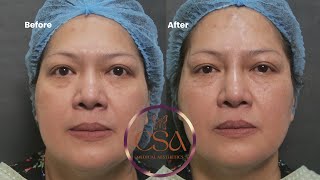 Periorbital rejuvenation undereye PDO threads foxeye nose threadlift  botox and forehead filler [upl. by Mansur]