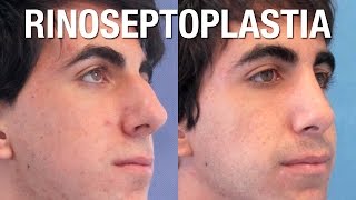 Rinoplastia Masculina  Antes y Después  Clínicas Diego de León [upl. by Marijo]