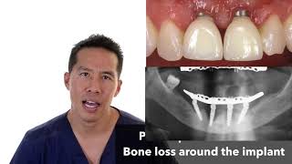 FAILING DENTAL IMPLANTS  how do we treat [upl. by Short]