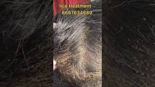 How to remove nits and lice treatment nits hair headlice haircare lice nits and lice removal [upl. by Vonny]