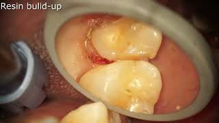 Maxillary premolar palatal cusp fractureresin build up [upl. by Bohannon]