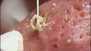 Blackheads Whiteheads Huge Pores Cystic acne Pimple popping [upl. by Suivatram]