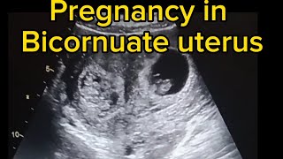 pregnancy in bicornuate uterus ultrasound case [upl. by Larianna]