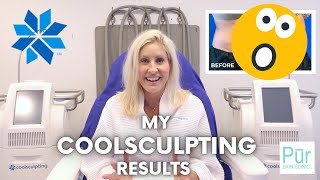 My COOLSCULPTING Results  CoolSculpting Before amp After  Does It Work  Pūr Skin Clinic [upl. by Ilatfan741]