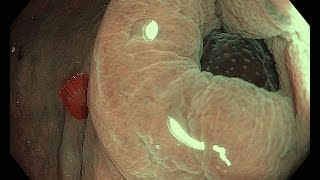 Polyp in appendix [upl. by Eveivaneg314]