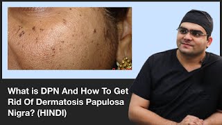 What is DPN And How To Get Rid Of Dermatosis Papulosa Nigra  ClearSkin Pune  In HINDI [upl. by Healion]