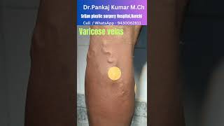 varicose veins treatment for SSC GD medical varicose veins treatment in Ranchi varicoseveins [upl. by Animor]