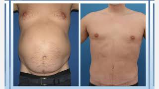 Testimonio de Abdominoplastia y Liposucción Hombres  Experiencia Personal [upl. by Mohammad103]