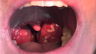 A patient with severe tonsillitis [upl. by Eniluqaj665]