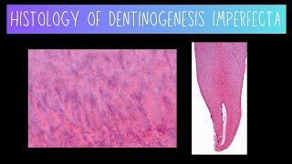 Histology of Dentinogenesis Imperfecta [upl. by Knowles]