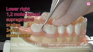 Lower right 12 molar buccal supragingival scaling 3435 sickle scaler [upl. by Bourne327]