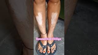 Vitiligo healthtipsinhindi dermatology skindiseases skin charmrog [upl. by Accire866]