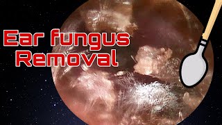 Ear fungus causes terrible itching  Earwax Removal  Doctor Anh [upl. by Carlene]