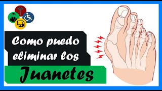 JUANETES en los pies como ELIMINARLOS [upl. by Forta]