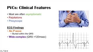 A Common Cause of Palpitations  Premature Ventricular Contractions PVCs Triggers amp Symptoms [upl. by Aillil]