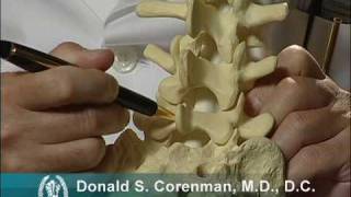 Isthmic Spondylolisthesis Video  Stress Fracture of the Back Vertebra  Spine Surgeon Colorado [upl. by Menendez]