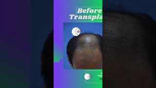 FUE Hair transplant at Dr humayun Institute Islamabad by Dr HumayunTotal number of grafts 3102 [upl. by Eadas887]