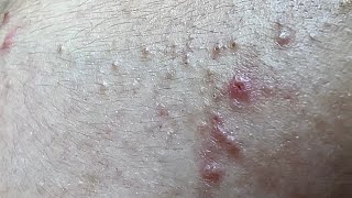 BLACKHEAD  Acne treatment Mai Ngoc [upl. by Zucker666]