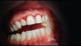 Get Rid Of Gum Disease FOR GOOD [upl. by Araec]