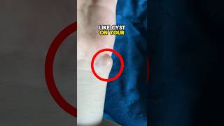 Remove This Dangerous Cyst At Home 😨 viral [upl. by Yelraf]