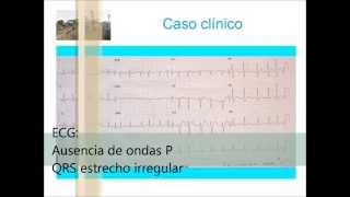 FIBRILACION AURICULAR SNU EL CALERO  GRAN CANARIA [upl. by Morgana]