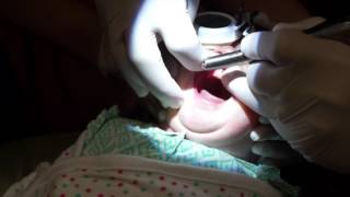 Lasers and infant teathered oral tissues tongue and lip ties [upl. by Nuncia967]