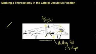 Positioning and marking a thoracotomymp4 [upl. by Okwu230]