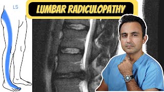 Lumbar Radiculopathy quotSciaticaquot [upl. by Ladnar]