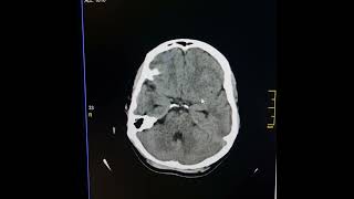 Cyst of cavum septum pellucidum causing mild obstructive hydrocephalus [upl. by Eisinger]