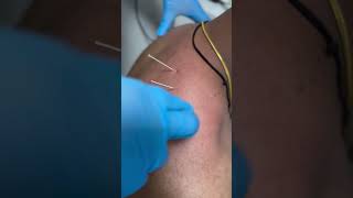 Dryneedling therapy for neck pain payal dryneedling ytshorts doctor physicaltherapy [upl. by Archer]