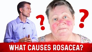 Dr Berg’s Opinion on Causes of Rosacea and Its Treatment [upl. by Alliw375]