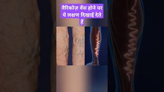 Symptoms of vericose veins vericoseveins ytshorts shorts [upl. by Anowahs193]