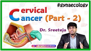 Cervical Cancer part 2  Obstetrics and gynaecology Video lectures  Medvizz app [upl. by Edea]