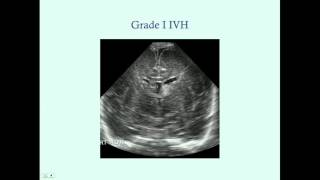 Intraventricular Hemorrhage  CRASH Medical Review Series [upl. by Phail400]