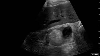 Hemorrhagic Renal Cyst US 1 unannotated JETem 2020 [upl. by Ayrotal]