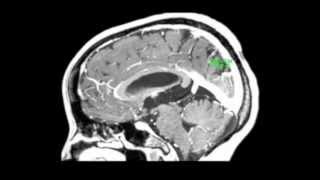 Endoscopic treatment of a third ventricle choroid plexus cyst [upl. by Atnoed]