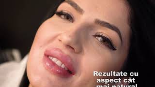 Buze mărite cu aspect natural cu acid hialuronic Juvederm 💋Augmentare buze💋SKiN BucureștiampCorbeanca [upl. by Semadar]