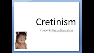 Pediatrics 135 Cretinism Congenital HypoThyroidism Child Umbilical Hernia Tongue Jaundice LOW ALP [upl. by Nana]