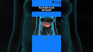 Gall bladder stone removal  Laproscopic Cholecystectomy  shortsviral [upl. by Kcinnay]