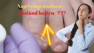 Abstand halten Bei eingewachsenem Nagel [upl. by Zirtaeb976]