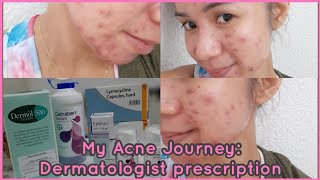 My Acne Journey Lymecycline Capsules Epiduo Gel Dermol 500 amp Cetraben Lotion  Gel Pines [upl. by Ajan]