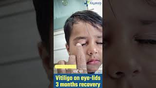 बच्चे में Eyelid Vitiligo की Recovery  3 Month Recovery  Kayakalp Global shorts shortsfeed [upl. by Freedman]