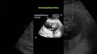 Anencephaly Fetus [upl. by Glover161]