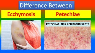 Distinction Between Ecchymosis and Petechiae [upl. by Viviana934]