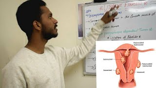 UTERINE FIBROID  SHORT REVIEW  MEDDY SIMPLIFIED  OBG [upl. by Teresina]