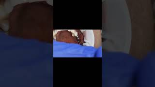 Molar implants 4 month post op osseointesratun  Tapping sound [upl. by Nodnab]