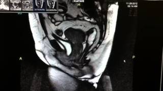 Defecography or proctogram for constipation [upl. by Eugine705]