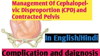 Management Of Cephalopelvic Disproportion CPD amp Contracted Pelvis II Nightingale Nursing Nursing [upl. by Spillihp]