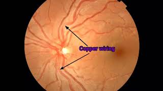 Hypertensive Retinopathy on Ophthalmoscope Cardiology  Medicine [upl. by Lledniuq]